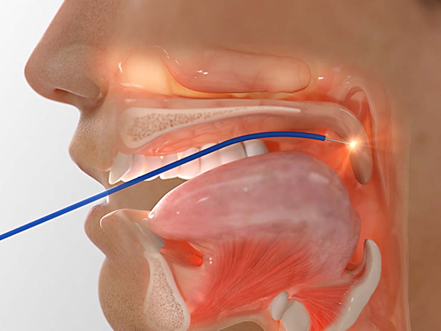 Transoral awake state neuromuscular electrical stimulation therapy for mild  obstructive sleep apnea